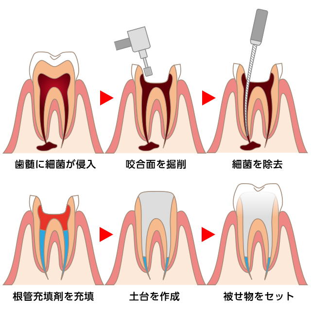 なるべく歯を残す『根管治療』