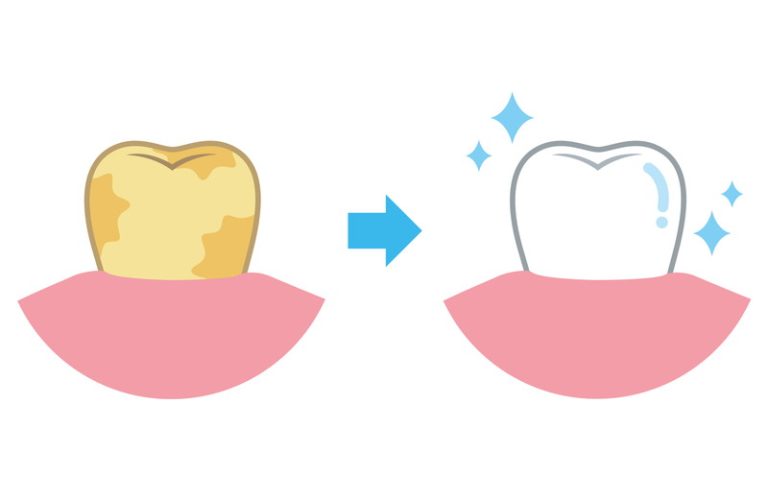 予防の早期発見で健康な歯を維持しましょう！